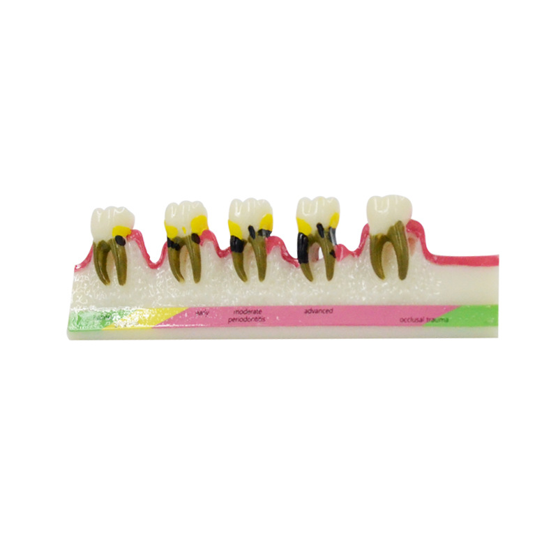 Periodontal Disease Model Dent - Medical Lab Study reseña y precio