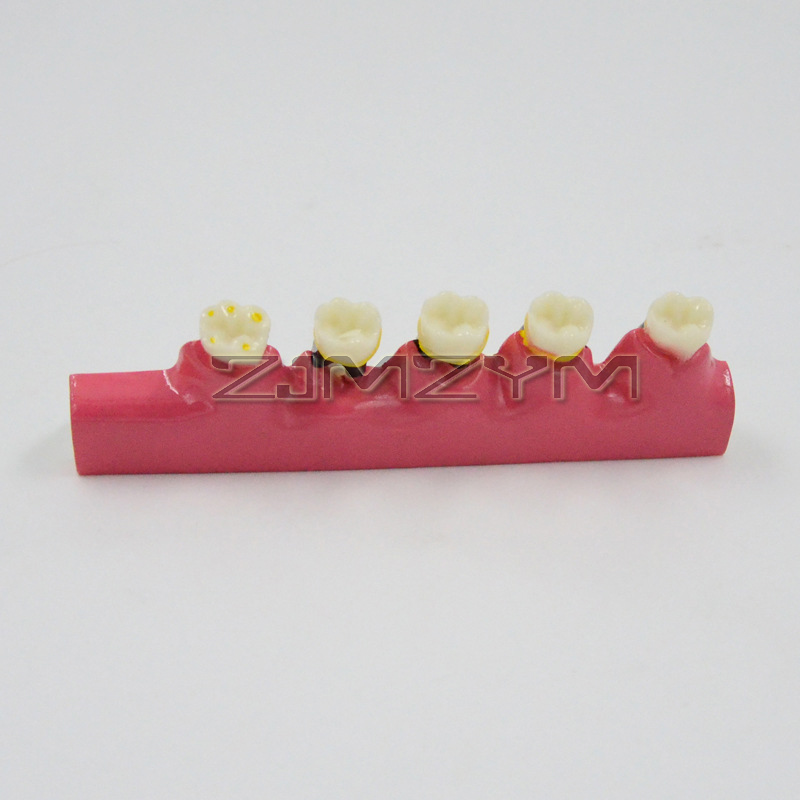 Periodontal Disease Model Dent - Medical Lab Study reseña y precio