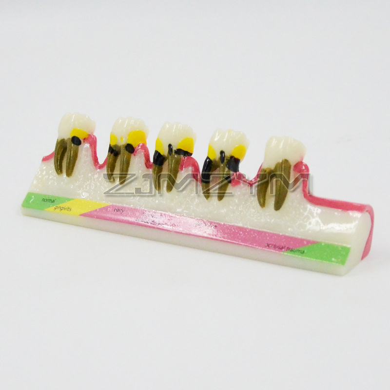 Periodontal Disease Model Dent - Medical Lab Study reseña y precio