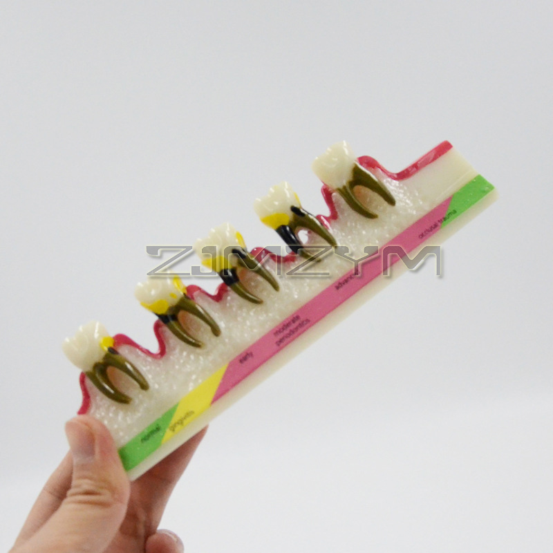 Periodontal Disease Model Dent - Medical Lab Study reseña y precio